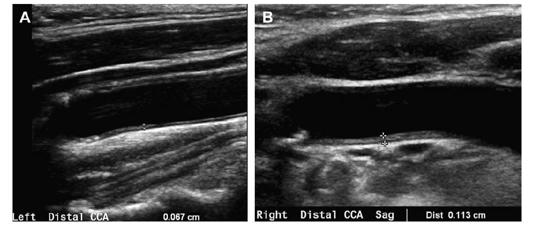 Ультразвуковое дуплексное сканирование брахиоцефальных артерий (УЗДСБЦА)