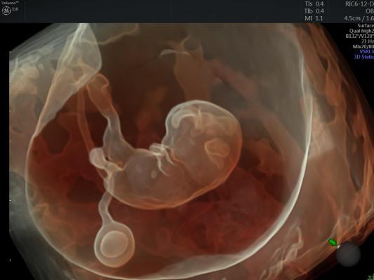X0000_GE_Volusion E10 ultrasound fetal 3D 4D image