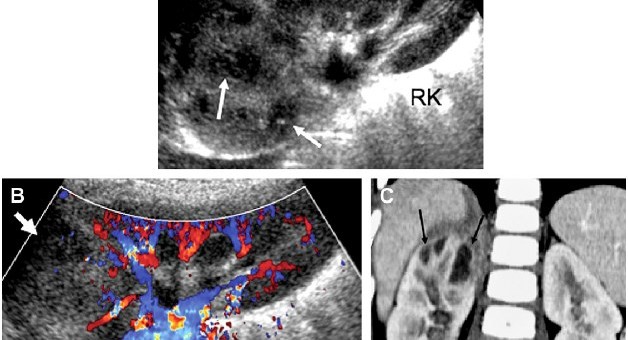 Ультрасонография в диагностике инфекции мочевыводящих путей у детей - Статьи RH