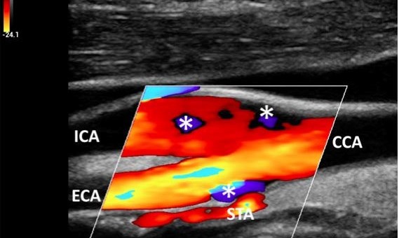 Методы векторной визуализации потока: инновационная ультразвуковая методика исследования кровотока - Статьи RH