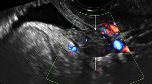 Трансвагинальная сонография в диагностике глубокого инфильтивного эндометриоза: обзор - Статьи RH