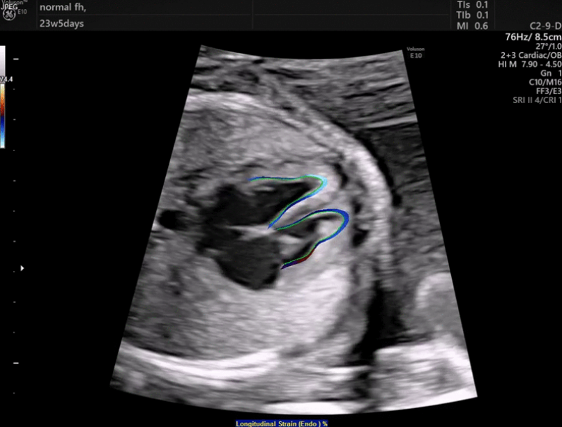 Нове програмне забезпечення від GE Healthcare - fetalHQ - спрощує діагностику вроджених вад серця! - Статті RH
