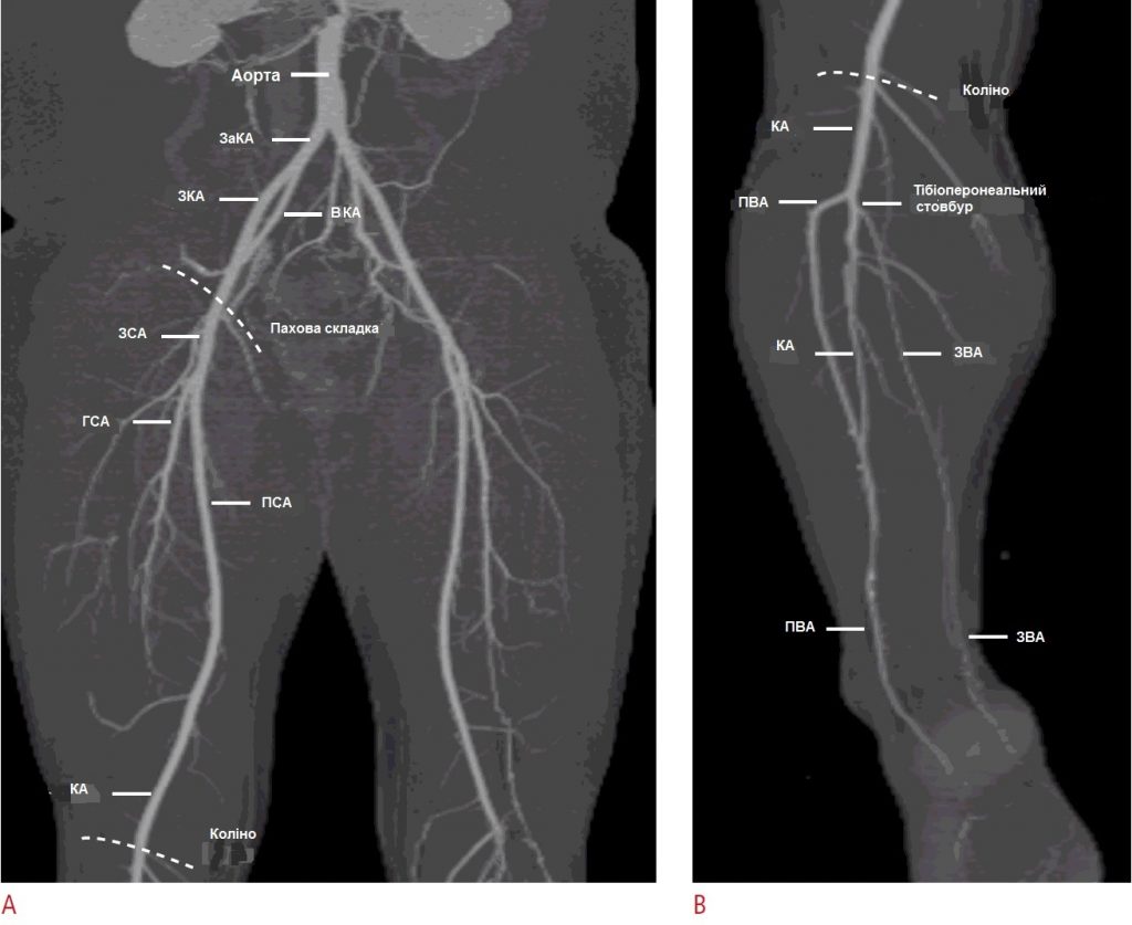 УЗД артерій нижніх кінцівок: - Малюнок1