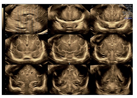 Тривимірна нейросонографія – нова - Малюнок6