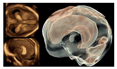 Тривимірна нейросонографія – нова - Малюнок9