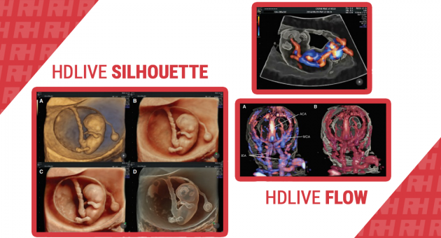 HDlive Silhouette и HDlive Flow – ультразвуковая эмбриология 3D - Статьи RH