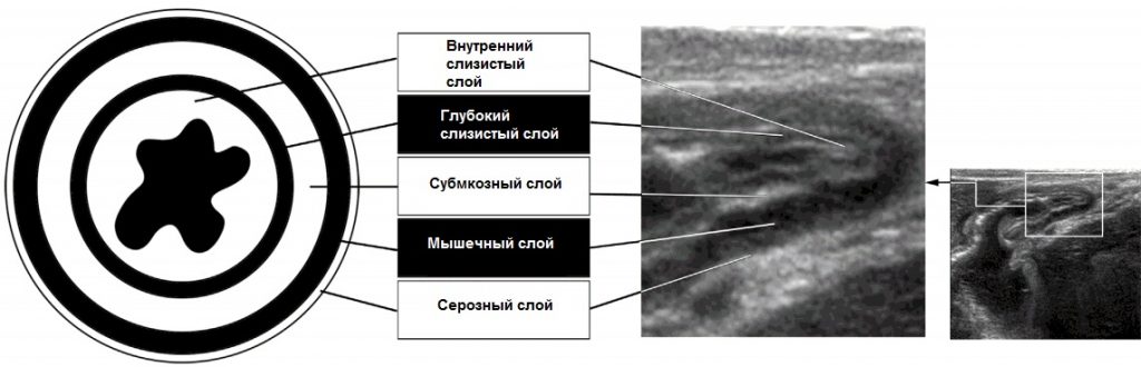 Экстренная ультрасонография желудочно-кишечного тракта - Рисунок2