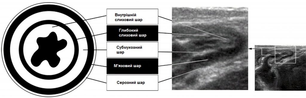 Екстрена ультрасонографія шлунково-кишкового тракту - Малюнок1