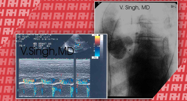 Ультразвуковая визуализация аортальной регургитации - Статьи RH