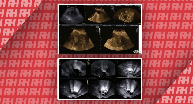 Великі множинні кістозні ураження в шийці матки: Диференціальна діагностика та значимість - Статті RH