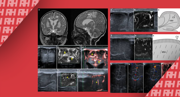 Микрососудистое УЗИ паренхимы головного мозга новорожденных: возможности, применение и нормальная визуализация с помощью SMI – Superb microvascular imaging - Статьи RH