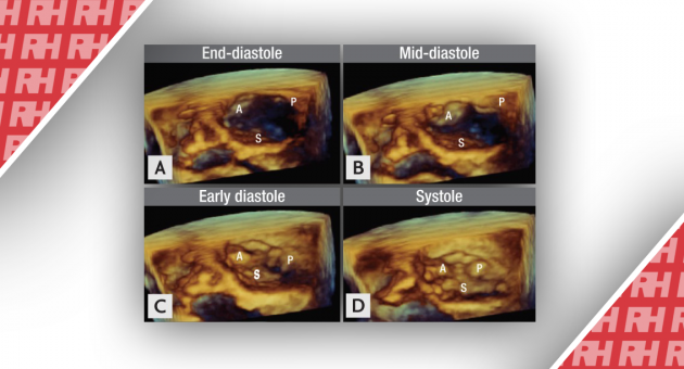 Роль сучасної 3D-ехокардіографії при захворюваннях клапанів серця - Статті RH