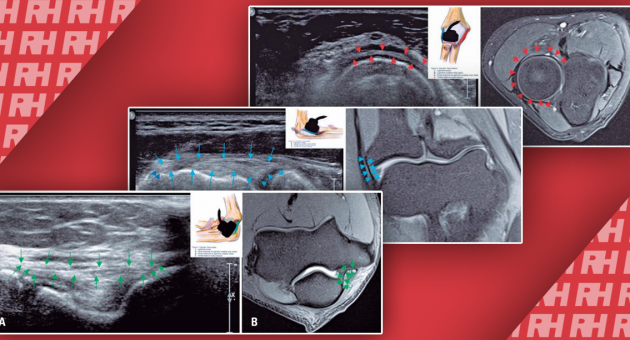 Ультрасонография и магнитно-резонансная томография связок локтевого сустава: сравнительное исследование - Статьи RH