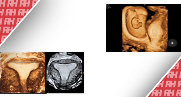 Ультразвуковая 3D-оценка матки: почему исследование точности врожденных аномалий невозможно, а скрининг – необходимая часть? - Статьи RH