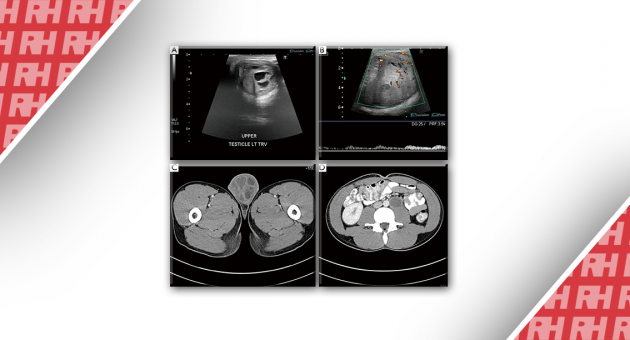 Роль диагностической визуализации при первичном раке яичка: начальная стадия - Статьи RH