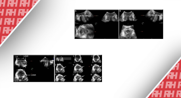 Застосування ультразвукової томографії та мультипланарного ультразвукового дослідження для виявлення пошкодження м’яза підіймаючого задній прохід у пацієнток з пролапсом тазових органів - Статті RH
