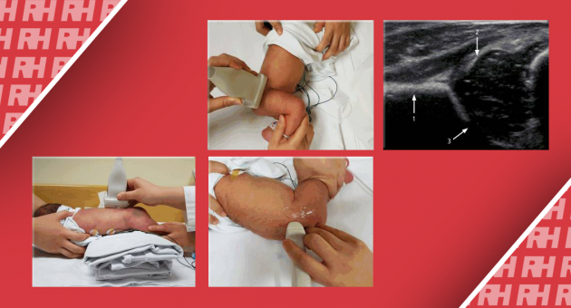 Ультразвукова діагностика тазостегнового суглоба і хребта у дітей - Статті RH