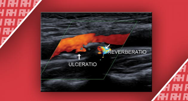 Ультрасонография уязвимых атеросклеротических бляшек в сонных артериях: визуализация в В-режиме - Статьи RH