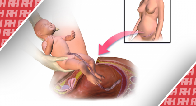 Плановий кесарів розтин або планові пологи через природні родові шляхи для близнюків: вторинний аналіз рандомізованого контрольованого дослідження - Статті RH