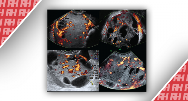 Ультразвукові ознаки злоякісних пухлин жовткового мішка яєчників (пухлини ендодермального синуса) - Статті RH