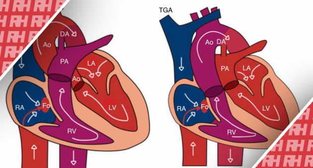 Пренатальная диагностика транспозиции магистральных артерий - Статьи RH