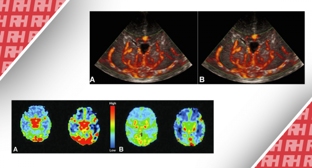 Визуализация перфузии головного мозга у новорожденных. Часть первая - Статьи RH