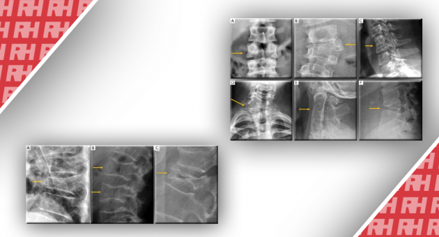 Роль рентгенографії в дослідженні захворювань хребта. Частина перша - Статті RH