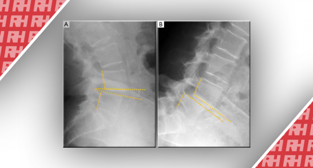 Роль рентгенографії в дослідженні захворювань хребта. Частина друга - Статті RH