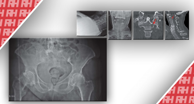Травматичні переломи у дорослих: пропущений діагноз на рентгенограмах у відділенні невідкладної допомоги - Статті RH