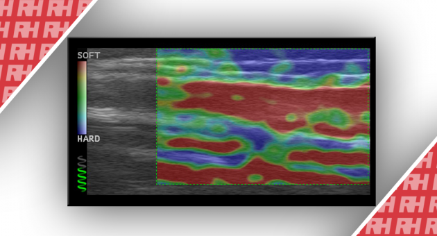 Использование ультразвуковой эластографии для определения возраста венозных тромбов. Оценка развития тромба у пациентов после склеротерапии - Статьи RH