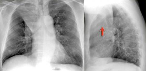 Рентгенологическая оценка лёгких: норма - Рисунок2