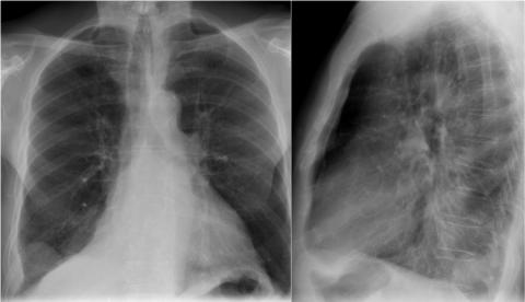 Рентгенологическая оценка лёгких: норма - Рисунок6