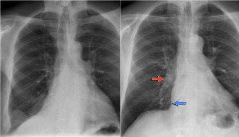 Рентгенологическая оценка лёгких: норма - Рисунок7