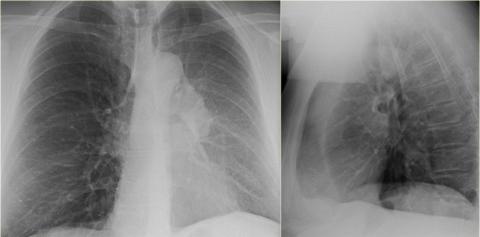 Рентгенологическая оценка лёгких: норма - Рисунок8