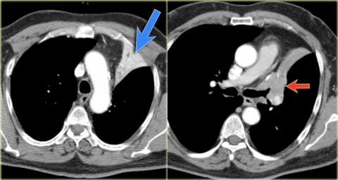 Рентгенологическая оценка лёгких: норма - Рисунок9