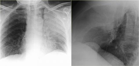 Рентгенологическая оценка лёгких: норма - Рисунок10