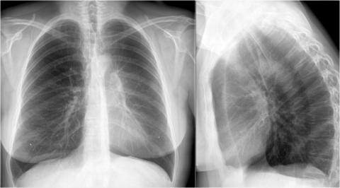 Рентгенологическая оценка лёгких: норма - Рисунок14