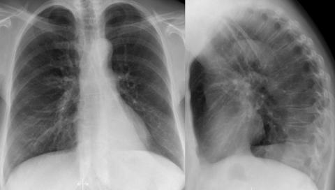 Рентгенологическая оценка лёгких: норма - Рисунок15