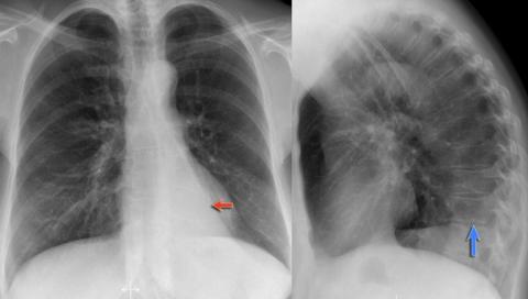 Рентгенологическая оценка лёгких: норма - Рисунок16