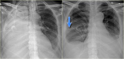 Рентгенологическая оценка лёгких: норма - Рисунок17