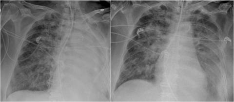 Рентгенологическая оценка лёгких: норма - Рисунок18