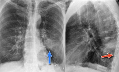 Рентгенологическая оценка лёгких: норма - Рисунок22