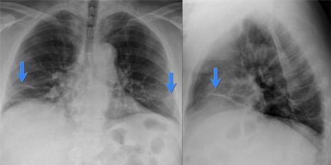 Рентгенологическая оценка лёгких: норма - Рисунок24