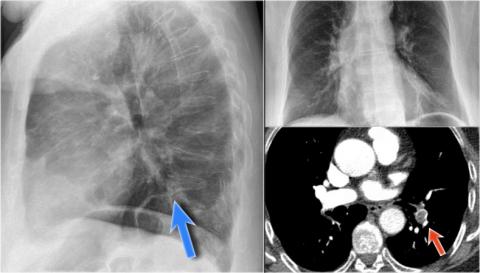 Рентгенологическая оценка лёгких: норма - Рисунок25