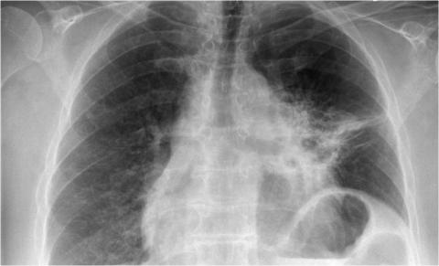 Рентгенологическая оценка лёгких: норма - Рисунок26
