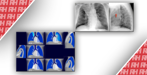 Рентгенологическая оценка лёгких: норма и патология. Часть вторая - Новини RH
