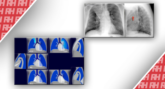 Рентгенологічна оцінка легень: норма та патологія. Частина друга - Статті RH