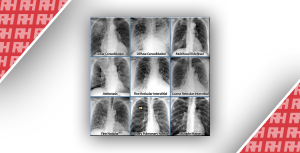 Рентгенологическая оценка лёгких: норма и патология. Часть первая - Новини RH