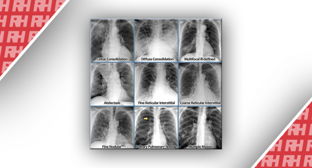 Рентгенологическая оценка лёгких: норма и патология. Часть первая - Статьи RH