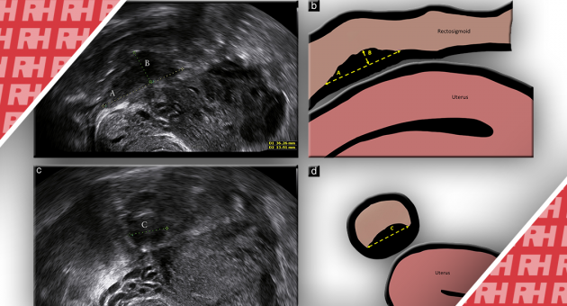 Трансвагинальная сонография точно определяет степень инфильтрации глубокого ректосигмовидного эндометриоза - Статьи RH